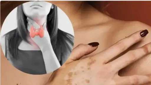 اليوم العالمي للبهاق.. كشف العلاقة بين المرض واضطرابات الغدة الدرقية