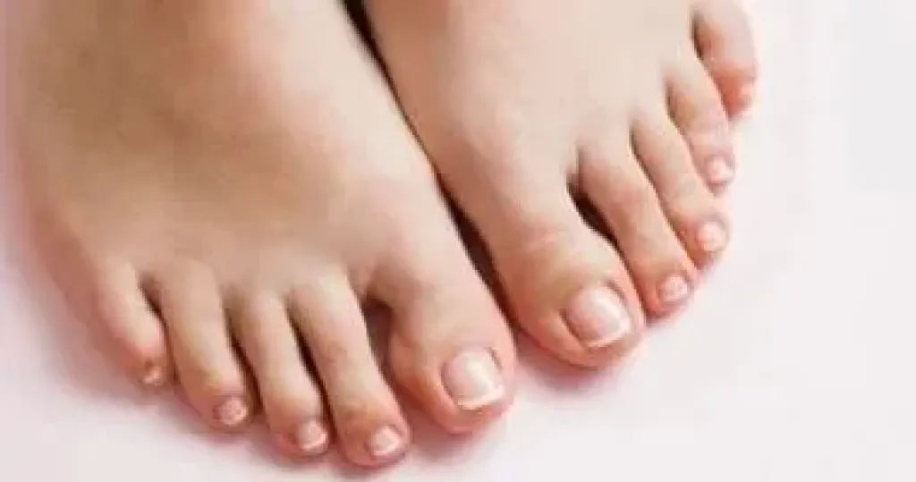 اسمرار اليدين والقدمين
