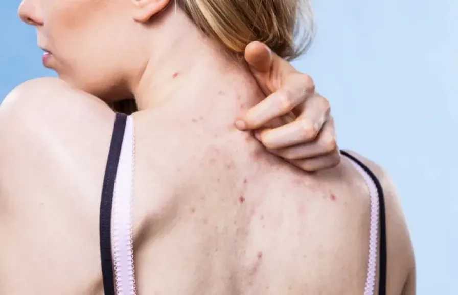 أسباب ظهور حب الشباب في الظهر والصدر: 6 عوامل رئيسية وطرق فعالة للعلاج والوقاية