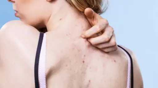 أسباب ظهور حب الشباب في الظهر والصدر: 6 عوامل رئيسية وطرق فعالة للعلاج والوقاية