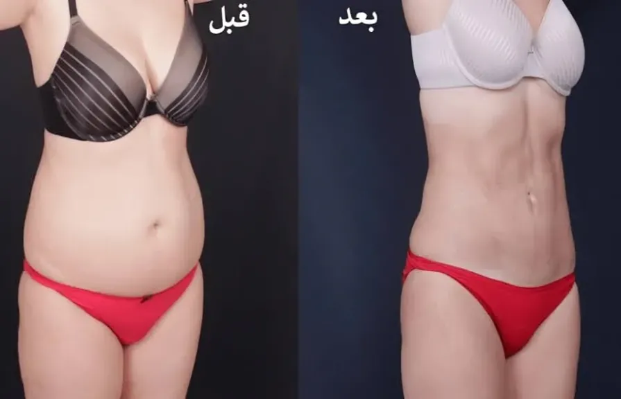 دهون البطن عند النساء