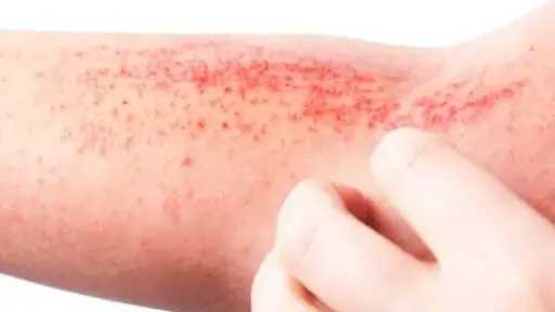 زيت شجرة الشاي.. فوائد مذهلة للبشرة والشعر وطريقة استخدامه بأمان