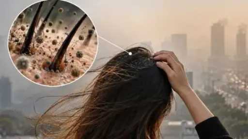 هل يتسبب تلوث الهواء في تساقط الشعر؟.. دراسات تكشف تأثير الجسيمات الدقيقة... هل يتسبب تلوث الهواء في تساقط الشعر؟.. دراسات تكشف تأثير الجسيمات الدقيقة على البصيلات