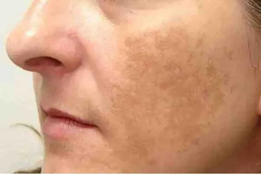 أسباب الكلف في الوجه وطرق علاجه.. نصائح مهمة للتخلص من البقع الداكنة