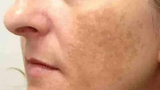 أسباب الكلف في الوجه وطرق علاجه.. نصائح مهمة للتخلص من البقع الداكنة أسباب الكلف في الوجه وطرق علاجه.. نصائح مهمة للتخلص من البقع الداكنة